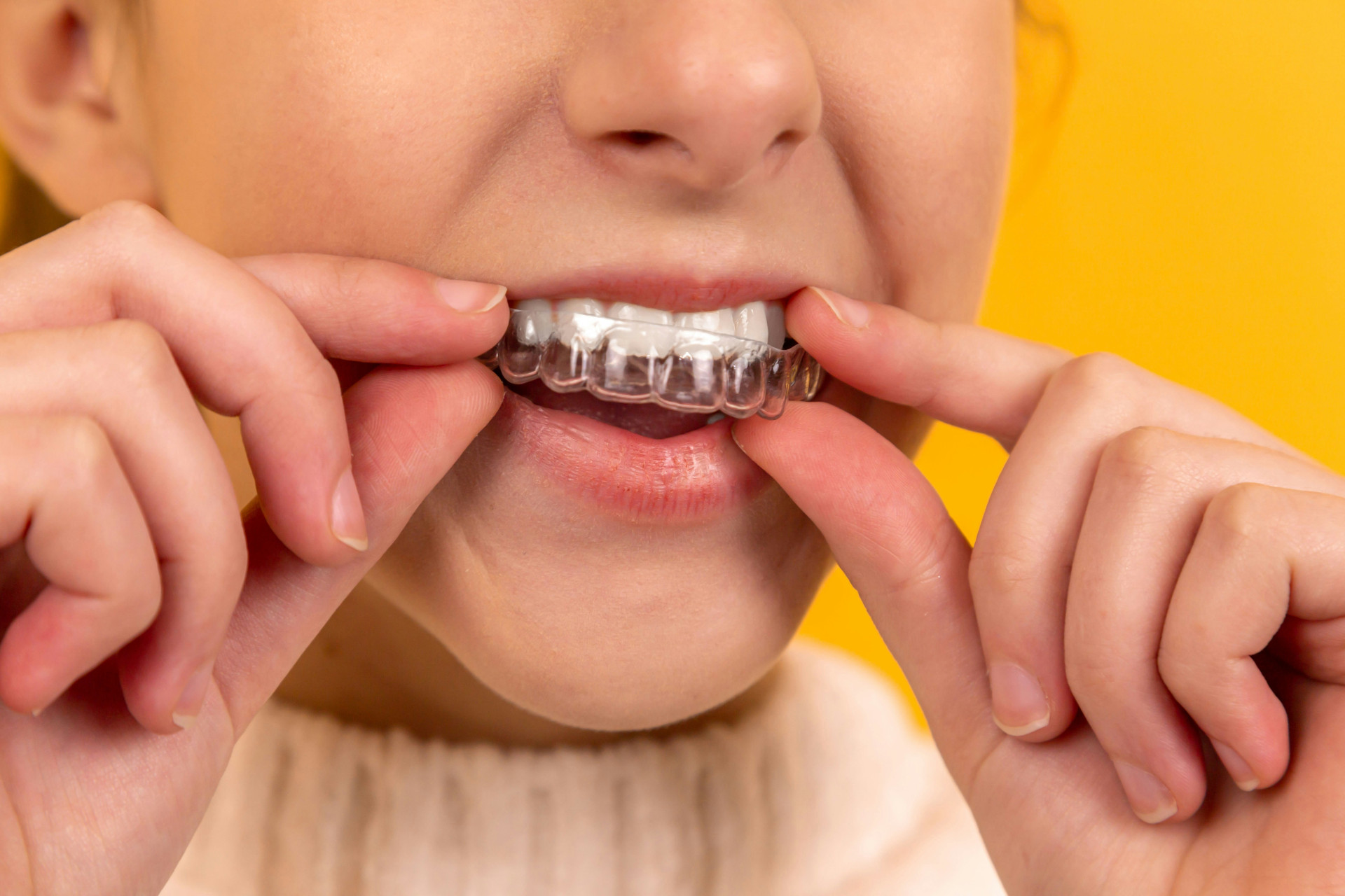 8 Reasons Why Clear Aligners Transform Your Smile and Confidence