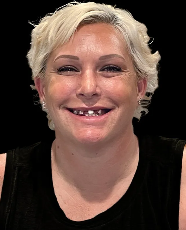 Patient 1 smile before dental implants