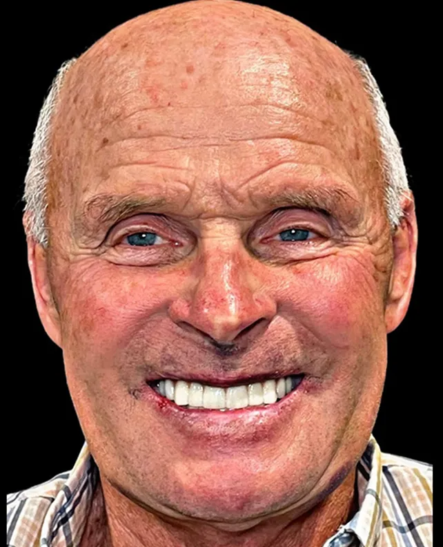 Patient 2 smile after dental implants