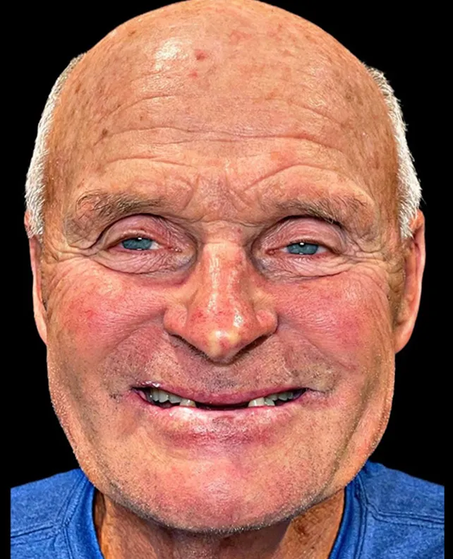 Patient 2 smile before dental implants