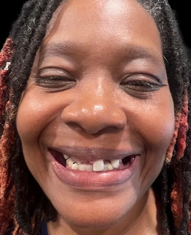 Patient 3 smile before dental implants